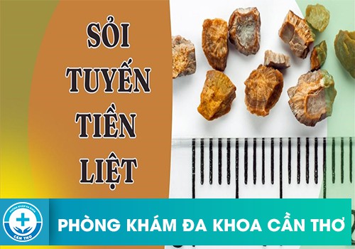 Bệnh sỏi tuyến tiền liệt và những nguy hiểm của bệnh