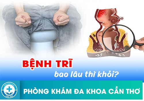 Thời Gian Điều Trị Bệnh Trĩ Khỏi Hẳn Trong Bao Lâu?