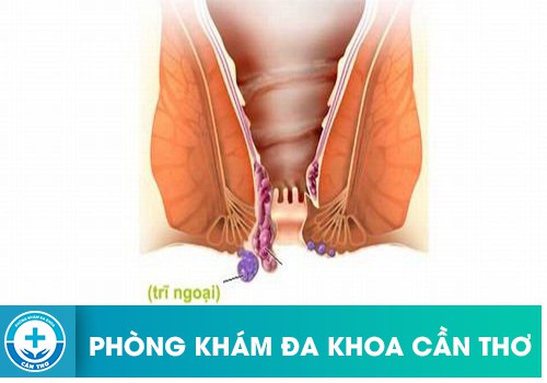 ⚕️ Phân Loại Trĩ Ngoại Để Có Phương Pháp Chữa Trị Hiệu Quả