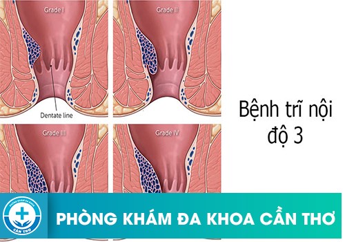 Bệnh Trĩ Nội Độ 3 Nên Dùng Phương Pháp Nào Điều Trị