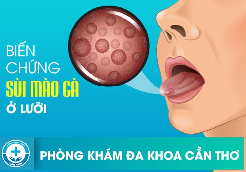 cách xét nghiệm sùi mào gà ở lưỡi 