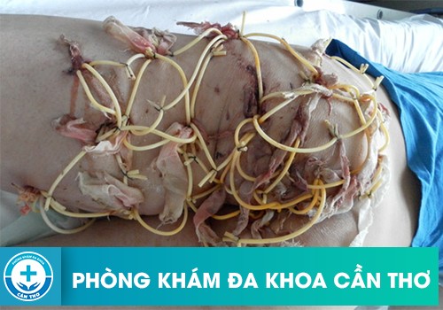 Biến chứng của bệnh rò hậu môn