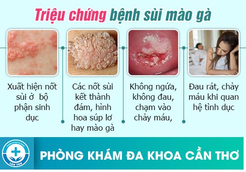 dấu hiệu nhận biết sùi mào gà dễ dàng