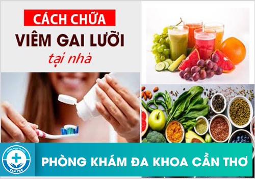 Các Cách Chữa Viêm Gai Lưỡi Tại Nhà Hiệu Quả