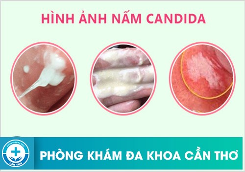 Các Cách Điều Trị Nấm Candida Ở Nam Giới