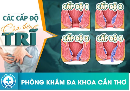 Chi phí chữa trị trĩ nội ở giai đoạn bệnh nặng sẽ tốn kém hơn