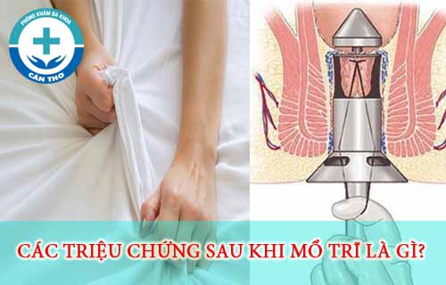 Đi CẮt TrĨ Bao LÂu ThÌ SẼ HẾt DỊch Ở HẬu MÔn