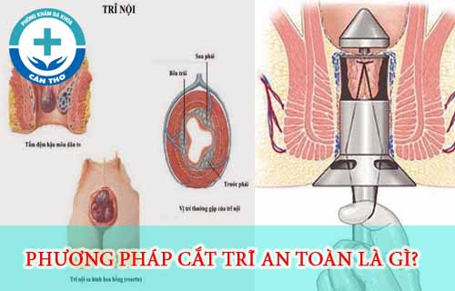 cat-tri-o-dau-an-toan-nhat