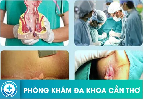 Cắt da thừa hậu môn có đau không