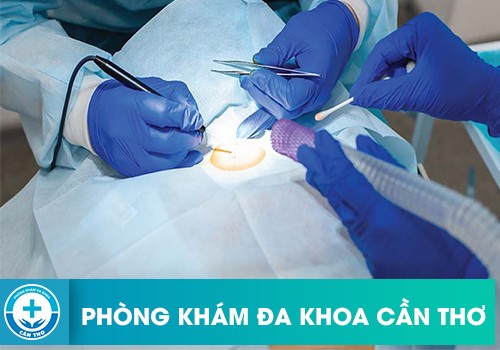 Phương pháp mổ điện bằng sùi mào gà