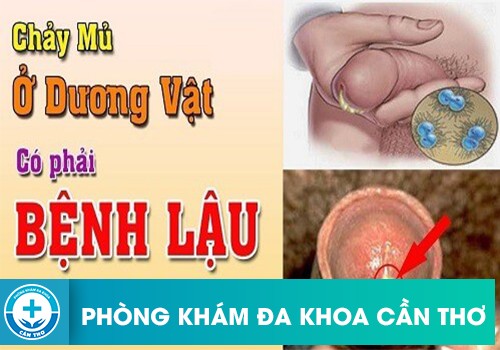 Đầu Dương Vật Chảy Mủ Có Phải Dấu Hiệu Bệnh Lậu không