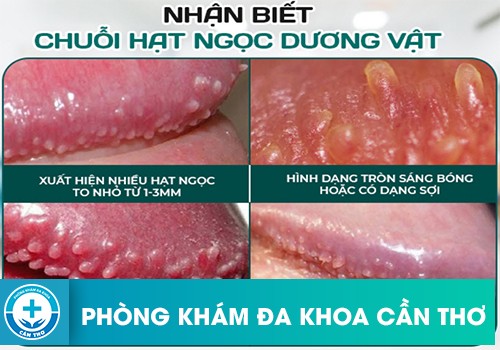 Chuỗi Hạt Ngọc Dương Vật Có Phải Là Sùi Mào Gà