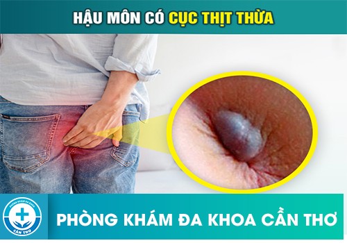 Nguyên nhân khiến cho hậu môn xuất hiện cục thịt thừa