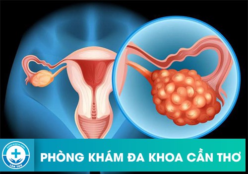 que thử thai có phát hiện đa nang buồng trứng không