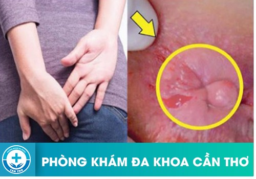 Lợi ích của cắt da thừa hậu môn