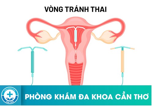 Có 2 loại đặt vòng tránh thai phổ biến hiện nay