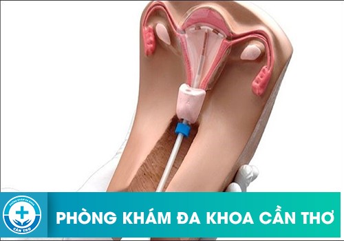 Nên đặt vòng tránh thai vào thời điểm nào?