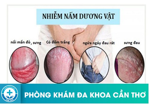 Dấu Hiệu Nhiễm Nấm Candida Ở Nam Giới