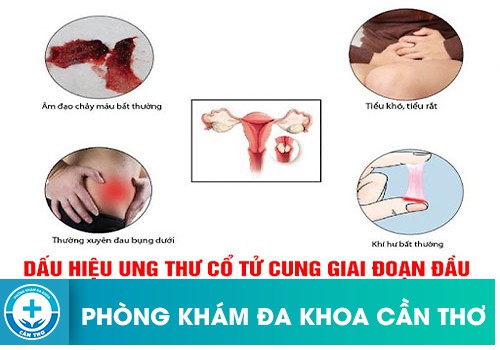 các giai đoạn ung thư cổ tử cung