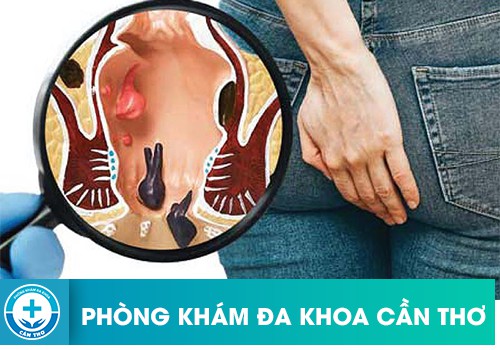 Tác hại của tình trạng viêm hậu môn