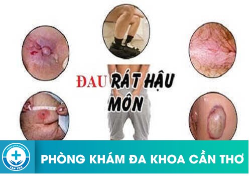 Bị Đau Rát Hậu Môn Trước Và Sau Đi Đại Tiện Là Bệnh Gì