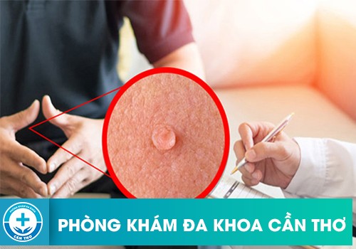 Địa chỉ xét nghiệm sùi mào gà uy tín tại Cần Thơ