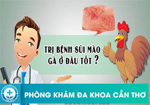 sùi mào gà ở nữ nên điều trị ở đâu