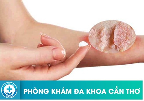 Những phương pháp điều trị bệnh sùi mào gà