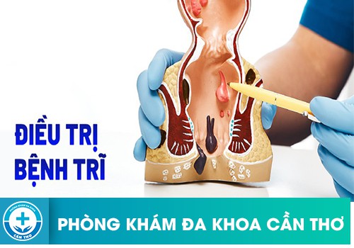 Phương pháp điều trị bệnh trĩ hiệu quả