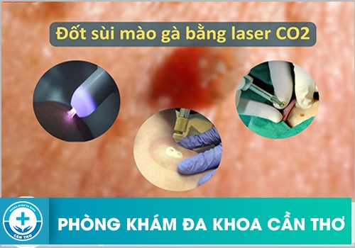 Điều trị bằng laser