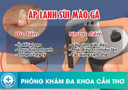 cách chữa sùi mào gà hiệu quả 