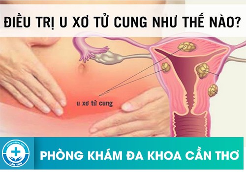 Điều trị u xơ tử cung bằng phương pháp gì?