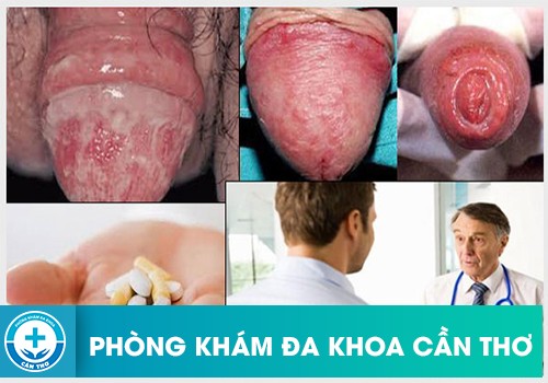 Phương pháp điều trị viêm bao quy đầu