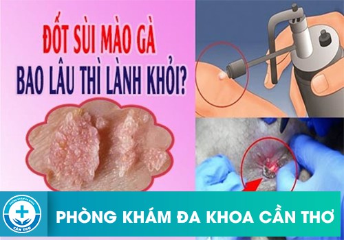 Vết Thương Điều Trị Sùi Mào Gà Bao Lâu Thì Khỏi Hẳn?