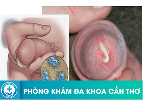 Nên làm gì khi dương vật chảy mủ?