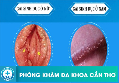 Hình ảnh gai sinh dục ở nam và nữ