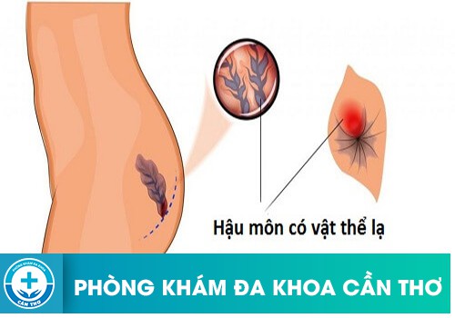 Nguyên nhân gây dị vật ở hậu môn