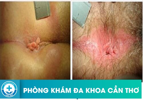 Có Nên Cắt Da Thừa Hậu Môn Không?