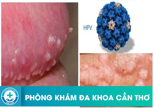 Triệu Chứng Bệnh HPV Ở Nam Giới