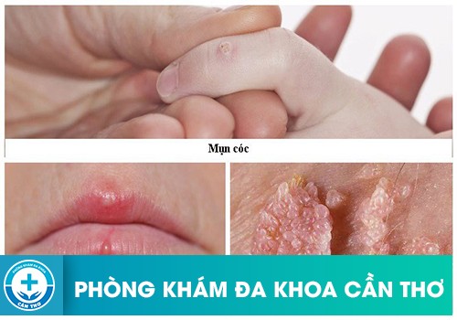 Dấu hiệu nhiễm virus HPV sinh dục