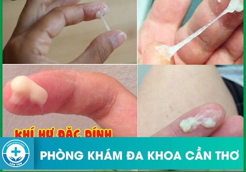 Khí hư đặc dính ảnh hưởng như thế nào đến sức khỏe phụ nữ