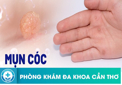 những loại mụn cóc thường gặp ở nam và nữ