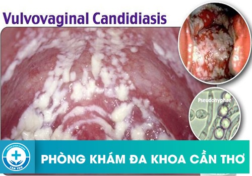  Viêm âm đạo do nấm Candida