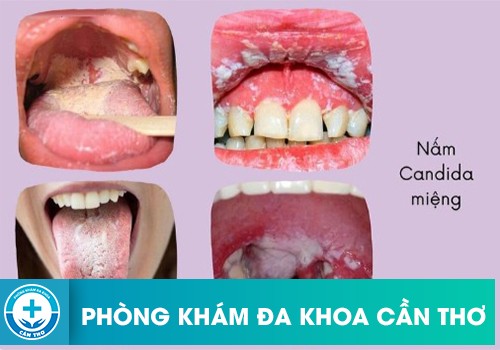 Biến chứng của nấm Candida ở miệng và họng