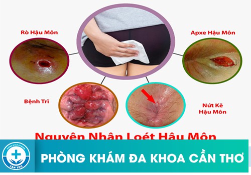 Nguyên nhân dẫn đến viêm loét hậu môn