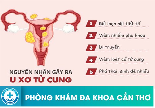 U xơ tử cung là gì?