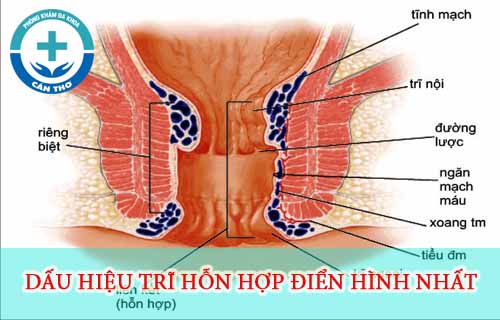 nhung-dau-hieu-tri-hon-hop