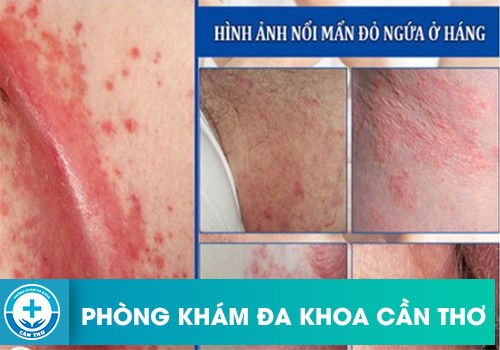 Bị ngứa nổi mẩn đỏ ở háng là bệnh gì?