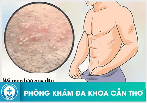 Vùng Da Bao Quy Đầu Nổi Mụn Trắng Là Bệnh Gì?