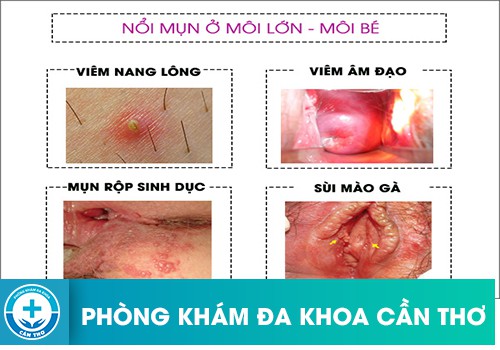 nổi mụn ở vùng kín